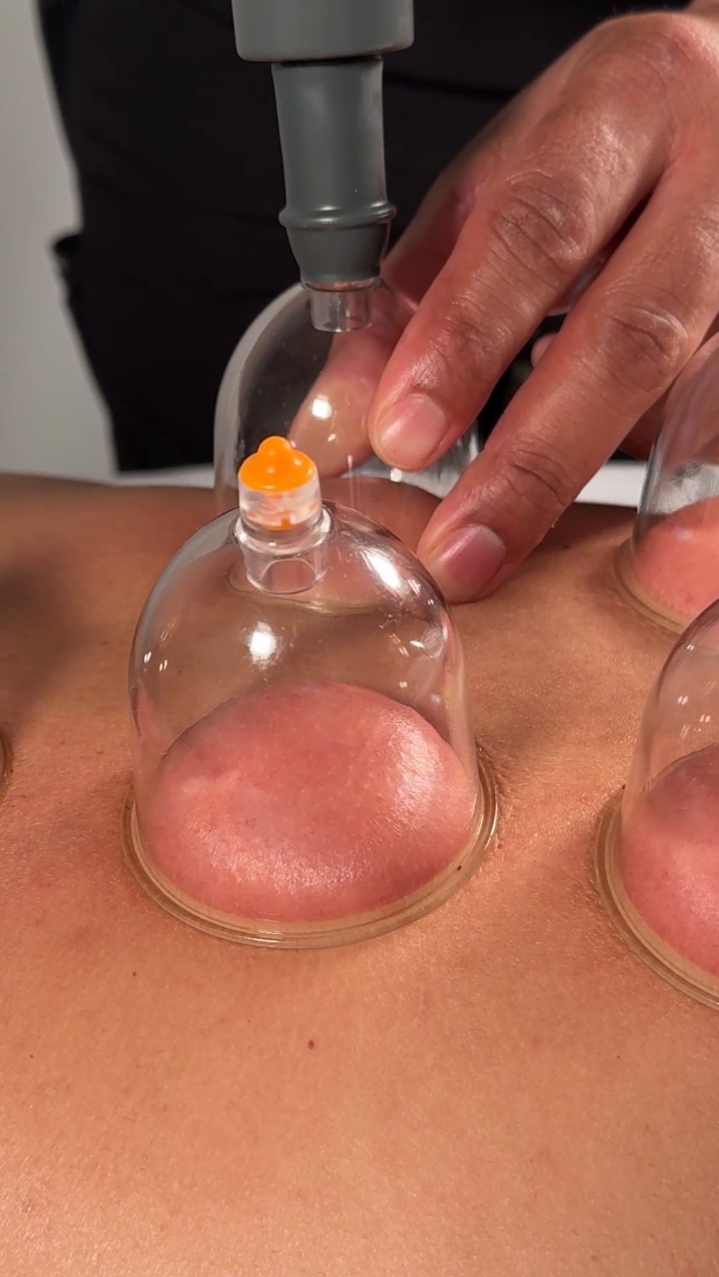 Terapia de ventosas